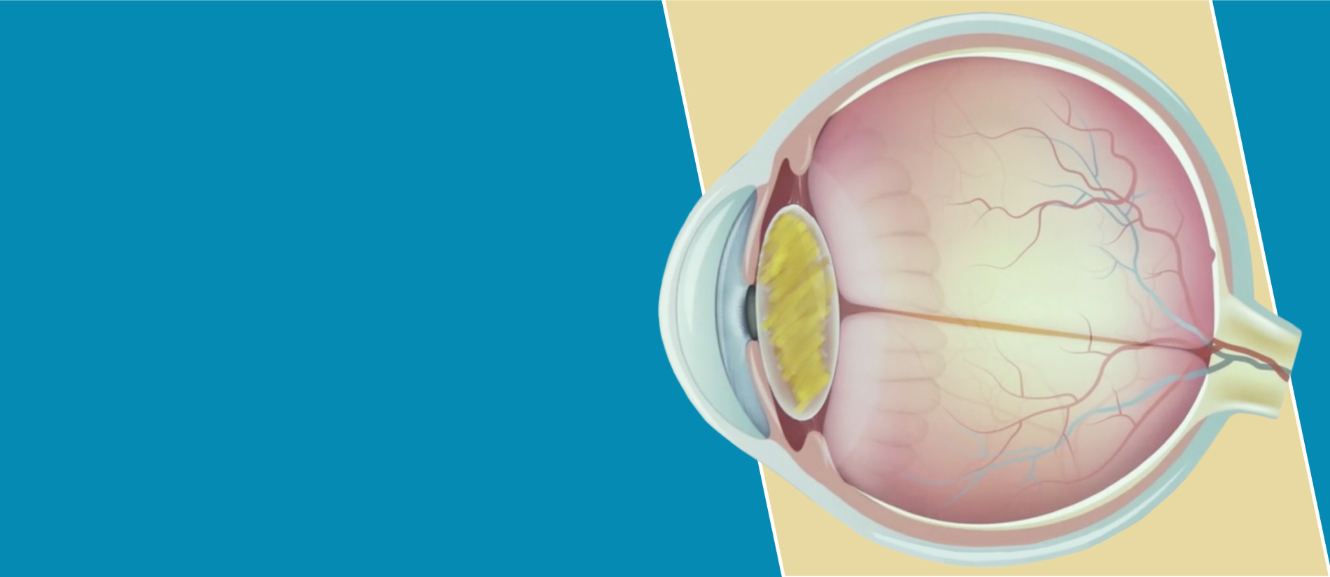 Learn about Cataracts